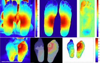 Imágenes en infrarrojo para la evaluación del pie diabético.